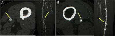 Lower limb arterial calcification and its clinical relevance with peripheral arterial disease